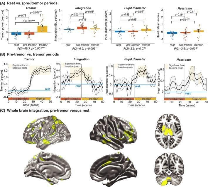 Educational infographic and diagnostic data visualization illustrating the pathophysiology of resting tremor in Parkinson's disease. Panel A contains bar plots comparing four parameters (Tremor power, Cerebral Integration, Pupil diameter, and Heart rate) across three states: rest, pre-tremor, and tremor. It shows that cerebral integration significantly increases during the pre-tremor phase before the onset of motor symptoms. Panel B presents time-series line graphs tracking the temporal evolution of these parameters, highlighting that cerebral integration peaks approximately 13 seconds prior to tremor onset, while autonomic markers like heart rate and pupil diameter co-fluctuate with the tremor itself. Panel C displays functional magnetic resonance imaging (fMRI) brain renderings in lateral, medial, axial, and coronal views. Highlighted yellow regions indicate areas of significantly increased between-network connectivity during pre-tremor states compared to rest, involving a diffuse network that includes the frontoparietal cortex, temporal lobes, thalamus, and cerebellum. This visual aids in understanding the neurobiological mechanisms where increased cerebral integration sets the stage for tremors, while the autonomic arousal system modulates their amplitude.
