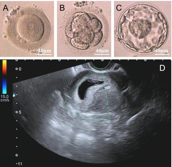 A multi-panel figure illustrating the stages of early human embryonic development and subsequent clinical pregnancy. Panels A-C are light microscopy images of an embryo at various pre-implantation stages, each with a 40 μm scale bar. Panel A shows a zygote at the 2-pronuclear (2PN) fertilization stage, with two distinct pronuclei visible within the cytoplasm. Panel B displays an 8-cell stage embryo, characterized by individual spherical blastomeres contained within the zona pellucida. Panel C depicts a high-quality blastocyst, showing a well-defined inner cell mass (ICM), a peripheral layer of trophectoderm cells, and an expanded fluid-filled blastocoel cavity. Panel D is a transvaginal ultrasound image demonstrating a successful clinical pregnancy. It reveals an intrauterine gestational sac appearing as an anechoic (dark), fluid-filled crescent-shaped structure surrounded by a hyperechoic decidual reaction. Color Doppler signaling is applied to the uterine environment to assess vascularity, with a velocity scale visible on the left. This visual sequence documents the progression from successful Intracytoplasmic Sperm Injection (ICSI) to embryo implantation and early gestation.