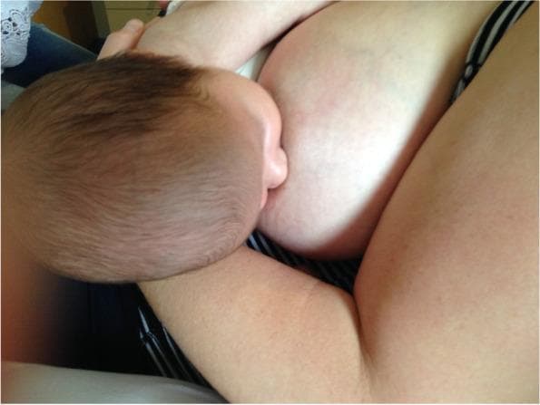 This clinical photograph demonstrates an infant breastfeeding, specifically illustrating an optimized latch following a gestalt intervention. The infant is positioned in close physical contact with the mother, demonstrating effective positioning and attachment. The infant's mouth is wide open and deeply latched onto the maternal breast, covering a significant portion of the areola. The infant's nose is in close proximity to the breast, and the chin is tucked into the breast tissue, supporting a stable, asymmetrical latch. The infant is supported by the mother's arm, ensuring a belly-to-belly orientation that facilitates proper alignment of the head, neck, and spine. This image serves as a clinical example of breastfeeding mechanics and positional stability, relevant for lactation consultancy and pediatric primary care. It highlights the visible contact points and body alignment necessary to maximize intra-oral breast tissue volume and potentially reduce maternal nipple pain associated with breastfeeding difficulties like tongue-tie or shallow latch.