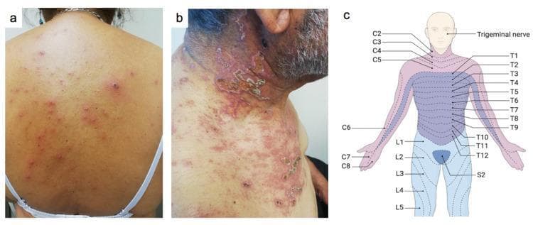A three-panel figure demonstrating the clinical presentation and anatomical context of varicella-zoster virus (VZV) infections. Panel (a) is a clinical photograph of a patient's back showing a generalized rash characterized by polymorphous lesions, including erythematous papules, vesicles on an erythematous base (the 'dewdrop on a rose petal' appearance), and crusts in various stages of evolution, typical of primary varicella (chickenpox). Panel (b) shows a clinical photograph of a localized, painful rash on the neck and upper chest of another patient, featuring clustered vesicles and confluent crusting on an erythematous background, following a dermatomal distribution. Panel (c) is an anatomical diagram of the human torso and head mapping the cervical (C2-C8), thoracic (T1-T12), lumbar (L1-L5), and sacral (S2) dermatomes, as well as the trigeminal nerve distribution. This figure illustrates the clinical distinction between primary varicella and herpes zoster (shingles) based on lesion morphology and dermatomal versus generalized distribution.