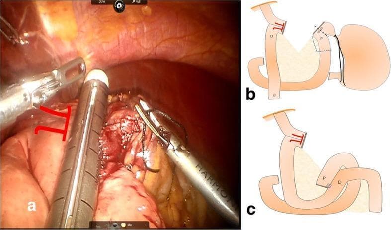 Educational medical composite depicting steps of an intracorporeal esophagojejunostomy following total gastrectomy. Figure A is a clinical laparoscopic photograph showing a 60-mm linear stapler being fired to convert two enterotomies into a single common entry hole, facilitating a functional end-to-end esophagojejunal anastomosis. Surgical graspers are visible manipulating the esophagus and jejunal limb, which is marked with red surgical dye. Figure B is a schematic diagram illustrating the resection phase, showing the stomach being detached along a primary resection line (black) and an optional proximal jejunal resection line (blue). Figure C is a schematic of the reconstructive phase, specifically a side-to-side jejunojejunostomy. Labels 'P' (proximal) and 'D' (distal) indicate the orientation of the bowel loops. The diagrams highlight the 'π-shaped' configuration of the anastomosis. This content is designed for surgical education regarding robotic-assisted or laparoscopic gastric bypass and oncological reconstruction techniques.