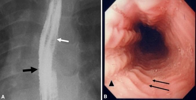 This dual-panel image displays diagnostic findings characteristic of Eosinophilic Esophagitis (EoE). Panel A is a lateral view of a barium esophagram showing a 'ringed' or 'corrugated' esophagus. A white arrow highlights multiple concentric, closely spaced esophageal rings, while a black arrow indicates mucosal irregularity and a narrow-caliber lumen. Panel B is a corresponding endoscopic image of the same patient, providing a luminal view. The endoscopy reveals prominent transverse concentric rings (feline esophagus appearance), indicated by black arrows, and longitudinal mucosal furrowing, indicated by an arrowhead. These features represent the classic remodeling and inflammatory changes seen in pediatric and adult patients presenting with dysphagia and food impaction. The side-by-side comparison demonstrates the radiological and endoscopic correlation of fixed esophageal rings and architectural distortion of the esophageal wall.