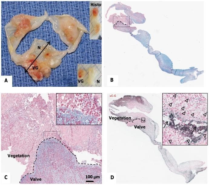 This composite educational image illustrates the macroscopic and histopathological characteristics of infective endocarditis on human heart valves. (A) Clinical photograph of an excised valve showing friable, reddish-brown vegetations (VG) contrasting against smooth, translucent normal tissue (N). (B, C) Light microscopy using Alcian blue and Nuclear Fast Red counterstain displays the interface between the septic thrombus (red-stained inflammatory cells and polylobed PMNs) and underlying valvular tissue exhibiting mucoid degeneration (blue-stained areas). The dotted line marks the clear boundary between the infected vegetation and the valve stroma. (D) TUNEL assay micrograph highlights the presence of cellular damage. Apoptotic cells (indicated by arrowheads) appear as dark, discrete nuclear spots, while extracellular fragmented DNA (indicated by arrows) shows diffuse, dark staining concentrated at the vegetation-valve interface. This visual series demonstrates the key pathological hallmarks of valvular infection, including thrombus formation, inflammatory infiltration, and programmed cell death.