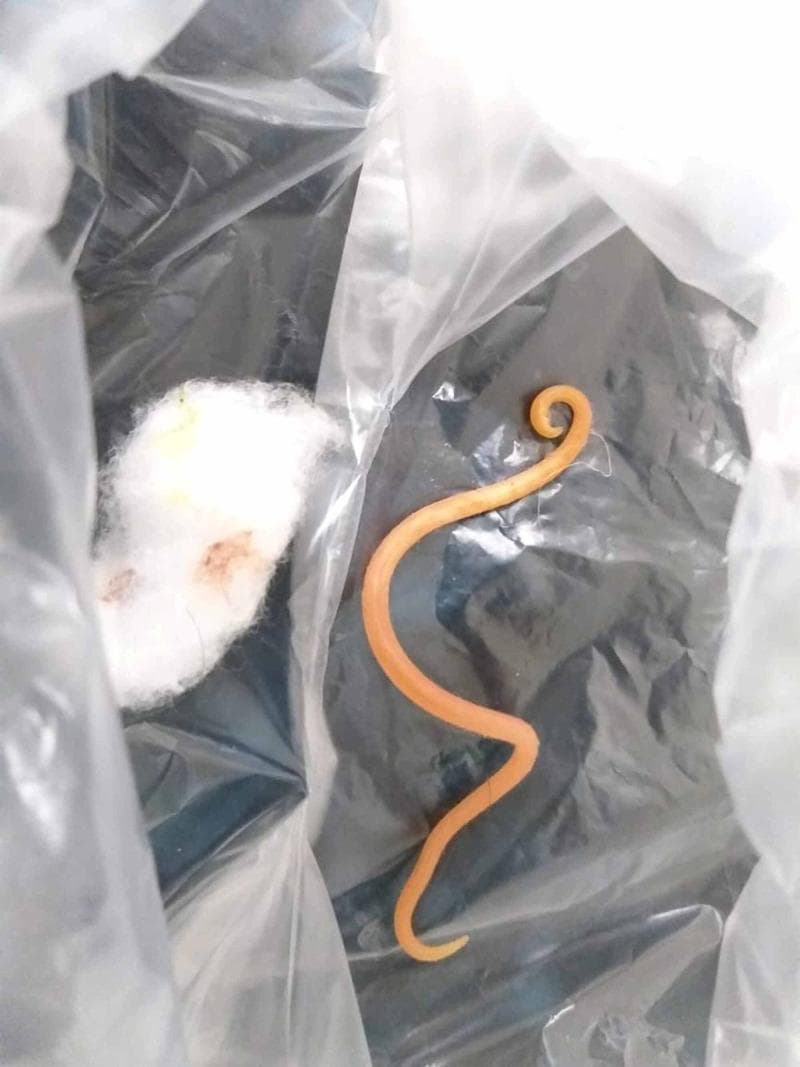 A clinical photograph of a gross pathology specimen featuring an adult nematode (roundworm), identified contextually as Ascaris lumbricoides. The specimen is displayed inside a clear specimen bag alongside a piece of white cotton wool for scale and handling. The roundworm exhibits characteristic morphology: a cylindrical, elongated, and unsegmented body with a smooth, light-orange to tan cuticle. One end demonstrates a distinctive curved or hooked appearance, while the other is tapered. The specimen measures approximately 15 cm in length. This visual provides evidence of ascariasis, a common parasitic infection where adult worms may be expelled via hematemesis or vomiting if they migrate from the small intestine to the stomach. The image is highly relevant for tropical medicine, gastroenterology, and infectious disease education, illustrating the gross appearance of a parasitic agent that can cause biliary or pancreatic complications.