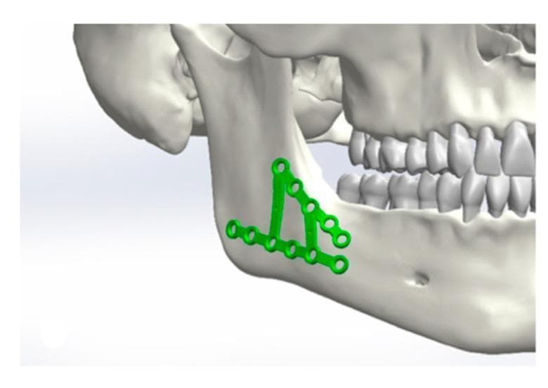 A digital 3D anatomical diagram illustrating the surgical fixation of a mandibular fracture using an osteosynthesis plate system. The model depicts a human skull in a lateral view, focusing on the mandibular angle and ramus. Two specialized green titanium mini-plates are shown applied to the cortical surface of the mandible: one horizontal plate positioned along the inferior border and a secondary oblique plate extending superiorly toward the anterior border of the ramus. Both plates feature multiple circular, countersunk screw holes designed for internal fixation. This visual serves as a surgical planning simulation to demonstrate the biomechanical positioning of internal fixation hardware in oral and maxillofacial surgery. The image highlights the relationship between the hardware and key anatomical landmarks, including the dental arch and the angle of the mandible.