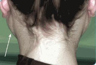 This clinical photograph shows a posterior-oblique view of a patient’s head and neck, highlighting significant bilateral enlargement of the parotid glands. The parotid swelling is visible as pronounced, non-inflammatory masses located anterior and inferior to the ears, extending toward the angle of the mandible. The overlying skin appears normal in texture and color, lacking the erythema or warmth typically associated with acute parotitis. An arrow indicates the area of hypertrophy on the left side. This presentation is characteristic of sialosis (sialadenosis), a non-inflammatory, non-neoplastic, and painless enlargement of the salivary glands. Clinically, this condition is often associated with systemic metabolic disorders, such as diabetes mellitus or chronic alcoholism, leading to acinar cell hypertrophy and adipose infiltration of the gland parenchyma. The image serves as an educational example of how systemic diseases can manifest as specific extraoral anatomical changes in the maxillofacial region.