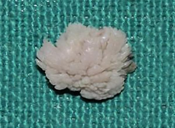 This clinical photograph displays a gross surgical specimen of an excised oral lesion against a green sterile backdrop. The specimen is a pale, pinkish-white, lobulated soft tissue mass measuring approximately 1.5 cm. Morphologically, the lesion exhibits a classic cauliflower-like or exophytic papillary architecture, characterized by numerous fine, finger-like (digitiform) projections and a fringed peripheral margin. These macroscopic features are highly characteristic of a squamous papilloma, often found on the hard palate. The image demonstrates the hallmark surface keratinization and papillary growth pattern used in the clinical identification of benign epithelial tumors of the oral cavity. Educational focus includes the recognition of verrucous and papillary lesions in oral pathology.