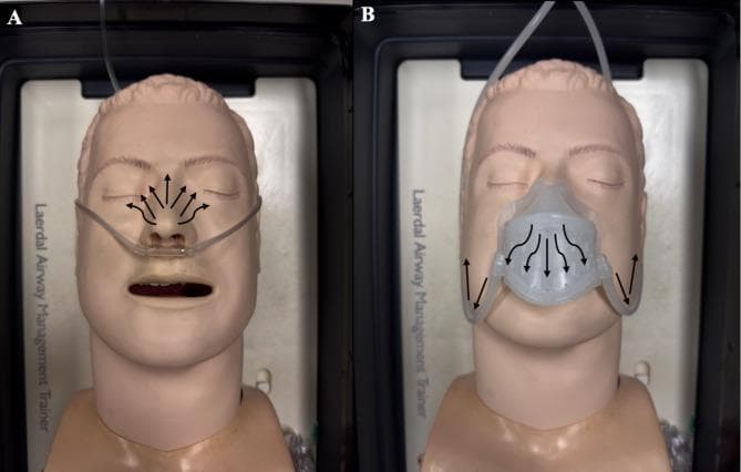 This comparison photograph illustrates a medical simulation study on oxygen flow using a supine airway management manikin. Panel A (unmasked condition) shows a nasal cannula delivery system with black arrows indicating the radial dispersion of oxygen flow upward and outward from the nares across the midface and toward the eyes. Panel B (masked condition) demonstrates a specialized oxygen scavenger mask covering the nose and mouth. Here, the black arrows indicate redirected oxygen flow downward toward the chin and peripheral venting away from the oculofacial field. The images are used to teach concepts of clinical safety, specifically the mitigation of high local oxygen concentrations near the eyes during surgical procedures to prevent fire hazards. The manikin features realistic anatomical landmarks including the nose, open mouth, and closed eyes, suitable for training in anesthesia and respiratory therapy.