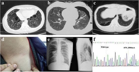 This multi-panel figure presents diagnostic findings consistent with Birt-Hogg-Dubé syndrome in a familial cohort. Panels (a), (b), and (c) are axial chest CT scans demonstrating bilateral, multiple thin-walled pulmonary cysts of varying sizes and distributions, characteristic of the condition. Panel (b) specifically highlights a concurrent pneumothorax. Panel (e) provides a corresponding posterior-anterior chest X-ray showing a collapsed lung with a visible pleural line and peripheral hyperlucency, confirming a pneumothorax. Clinical manifestations are further illustrated in panel (d), showing cutaneous papules (fibrofolliculomas/angiofibromas) on the neck. Panel (f) contains a DNA sequencing chromatogram comparing a wild-type sequence to a frameshift mutation (c.1579_1580insA) in exon 14 of the FLCN gene. The combination of cystic lung disease, spontaneous pneumothorax, cutaneous lesions, and genetic confirmation highlights the multisystemic nature of this autosomal dominant disorder.