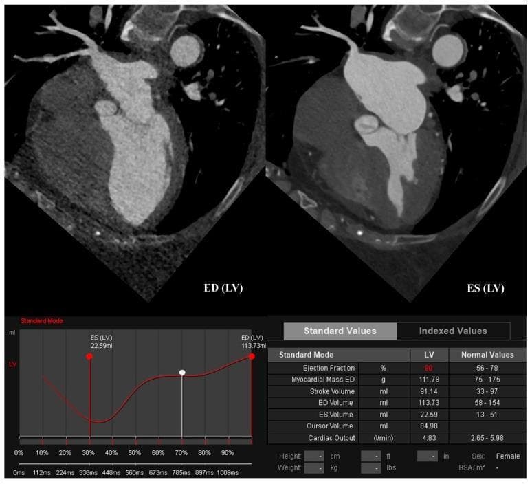 This diagnostic image displays a cardiac computed tomography angiography (CCTA) focused on left ventricular (LV) function assessment. The composite includes two side-by-side sagittal oblique views of the heart: the left frame shows the LV at end-diastole (ED), and the right frame shows it at end-systole (ES), illustrating the change in chamber volume during the cardiac cycle. Below the images is a quantitative analysis panel featuring a volume-time curve and a 'Standard Values' table. The data quantifies normal systolic function with an ejection fraction (EF) of 80%, a stroke volume (SV) of 91.14 mL, an end-diastolic volume (EDV) of 113.73 mL, and an end-systolic volume (ESV) of 22.59 mL. Additional parameters listed include a myocardial mass of 111.78 g and a cardiac output of 4.83 L/min. This clinical imaging tool is used in cardiology and radiology to objectively evaluate ventricular performance, wall motion, and myocardial health.
