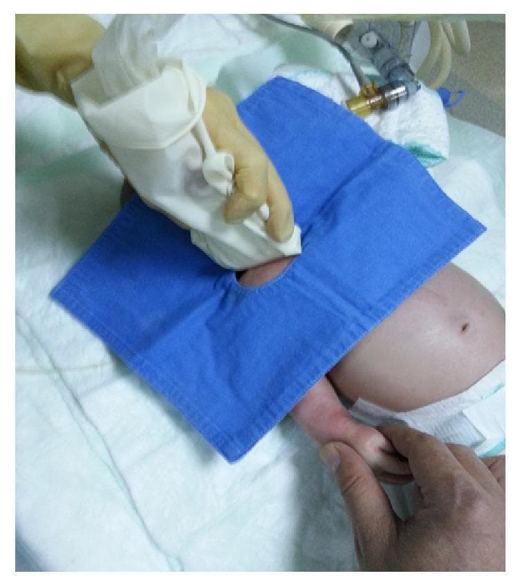 This clinical photograph demonstrates the setup for an ultrasound-guided vascular access procedure, specifically a supraclavicular approach for subclavian vein (SCV) cannulation in a neonate. The patient is in a supine position with the head rotated toward the contralateral side. The target area is draped with a blue sterile fenestrated surgical sheet. A high-frequency linear ultrasound transducer, encased in a sterile cover, is held by a practitioner using a gloved hand at the supraclavicular region. A second individual is seen stabilizing the infant's right arm, pulled caudally to optimize exposure of the thoracic inlet and subclavian vessels. Key clinical elements include the maintenance of an aseptic field and the specific ergonomics required for pediatric central venous catheterization. This visual serves as a procedural guide for real-time ultrasound guidance in neonates with difficult peripheral access or anatomical challenges such as a short neck or edema.