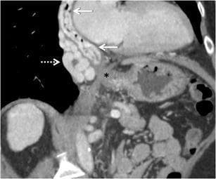 This coronal-oblique maximum intensity projection (MIP) contrast-enhanced CT (CECT) image illustrates portosystemic collateral pathways in a patient with portal hypertension. The primary focus is the distal esophagus and the gastro-oesophageal junction (marked with an asterisk). Multiple dilated, tortuous venous collaterals are evident in two distinct anatomical compartments: intramural oesophageal mucosa varices (identified by solid white arrows) and para-oesophageal collaterals (highlighted by a dashed arrow) located outside the esophageal wall. These findings demonstrate the typical cephalad hepatofugal flow from the portal system toward the azygos and hemiazygos systems. The image serves as an educational tool for differentiating intrinsic varices, which carry a high risk of gastrointestinal hemorrhage, from extrinsic para-oesophageal collaterals. The anatomical relationship of these vessels to the gastro-oesophageal junction is a key diagnostic feature in evaluating the severity of portal hypertension and planning potential interventions like sclerotherapy or TIPS.