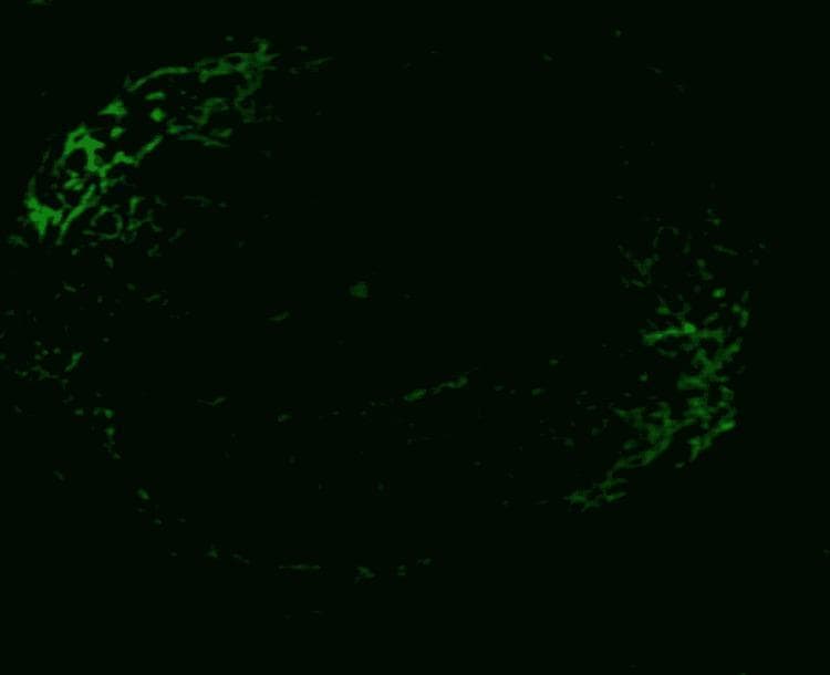 This diagnostic image shows a renal biopsy specimen examined under immunofluorescence microscopy. The focus is a single glomerulus against a dark background, illustrating negative immunofluorescence for linear immunoglobulin G (IgG). Instead of the continuous, smooth, 'ribbon-like' linear staining characteristic of anti-glomerular basement membrane (anti-GBM) disease, this image displays weak, irregular, and interrupted green fluorescence along the capillary loops. The distribution is sparse and non-specific, lacking the defined morphology expected in positive cases. Clinically, this visual finding is significant in the context of crescentic glomerulonephritis; despite the presence of circulating anti-GBM antibodies in the patient, this specific immunofluorescence study does not demonstrate the classic pathognomonic linear deposition of antibodies on the glomerular basement membrane, likely due to technical factors related to paraffin-embedded material processing.
