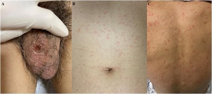 This composite of clinical photographs illustrates the dermatological manifestations of scrub typhus (Orientia tsutsugamushi infection). Panel A displays a characteristic eschar located on the scrotum. The lesion is approximately 1 x 1 cm, presenting as an erythematous to black ulcerative area with a central necrotic crust. Panels B and C show the associated systemic skin involvement, characterized by a diffuse, blanching maculopapular rash distributed across the trunk (B) and the back (C). The rash consists of multiple small, pink-to-red macules and papules that are non-confluent. These findings are diagnostic hallmarks of rickettsial diseases, where the eschar represents the site of the chigger bite and the generalized rash indicates hematogenous dissemination. This clinical presentation, combined with a history of outdoor exposure, is used to identify vector-borne infectious diseases in endemic regions.