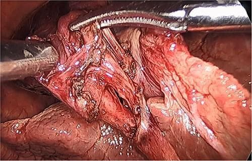 This laparoscopic intraoperative clinical photograph illustrates the achievement of the 'Critical View of Safety' during a cholecystectomy for gallbladder volvulus. The field shows the hepatobiliary triangle (Calot's triangle) following surgical dissection. Visible structures include the cystic duct and cystic artery, which have been isolated and cleared of surrounding fibrofatty tissue. The gallbladder appears distended with darkened, hemorrhagic walls consistent with gangrenous necrosis due to torsion. The liver surface is visible in the background, showing the lower third of the cystic plate cleared to ensure anatomical identification. Metal surgical graspers are positioned to retract the gallbladder and facilitate exposure of the ductal and vascular structures. This image serves as an educational example of proper surgical identification techniques to prevent bile duct injury during complex cholecystectomy procedures involving anomalous gallbladder positions and vascular compromise.