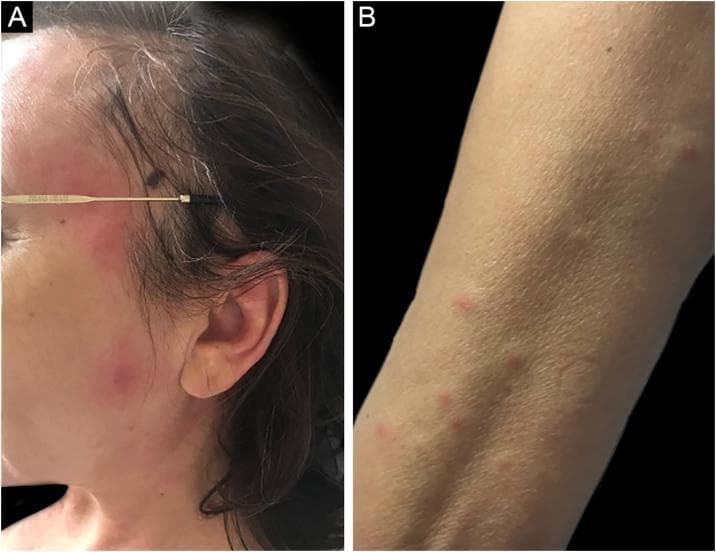 Two-panel clinical photograph illustrating the dermatological manifestations of Sweet syndrome (acute febrile neutrophilic dermatosis) in a patient with acute myeloid leukemia (AML). Panel A shows the lateral aspect of the face featuring multiple erythematous-edematous plaques and papules. The lesions are red-to-violaceous, raised, and relatively well-defined, concentrated on the cheek and periorbital region. Panel B displays the anterior forearm with smaller, discrete erythematous papules scattered across the skin surface. The lesions in both sites lack secondary features such as scaling, crusting, or ulceration. This visual demonstrates the classic 'succulent' or edematous appearance of neutrophilic dermatoses. The educational focus is on recognizing malignancy-associated skin signs, specifically the abrupt onset of painful, inflammatory lesions in a patient with an underlying hematologic disorder like MDS or AML.