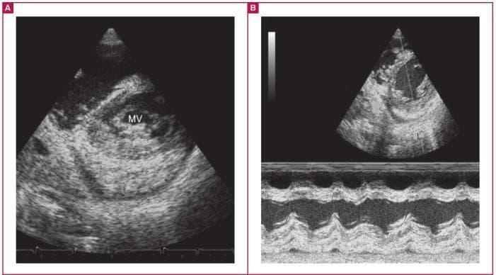 Diagnostic ultrasound images demonstrating classic echocardiographic features of advanced endomyocardial fibrosis (EMF). Panel A presents a short-axis transthoracic echocardiogram view showing the characteristic 'layering' effect of the posterior cardiac wall. This layering consists of three distinct, thickened zones: the hyperechoic endocardium, the myocardium, and the thickened pericardium. The posterior mitral valve (MV) leaflet is clearly visible and tethered to the underlying fibrotic endocardium, a hallmark of endocardial restriction. Panel B displays an M-mode echocardiogram across the posterior wall, further highlighting the anatomical separation of the three layers. The M-mode confirms significant endocardial thickening and a fibrosed, thickened pericardium associated with small peripheral pericardial effusions. These images illustrate the progressive fibrotic transformation of the heart's internal and external layers, which leads to restrictive physiology and valvular dysfunction. This material is suitable for advanced cardiology education focusing on restrictive cardiomyopathies and tropical cardiology.