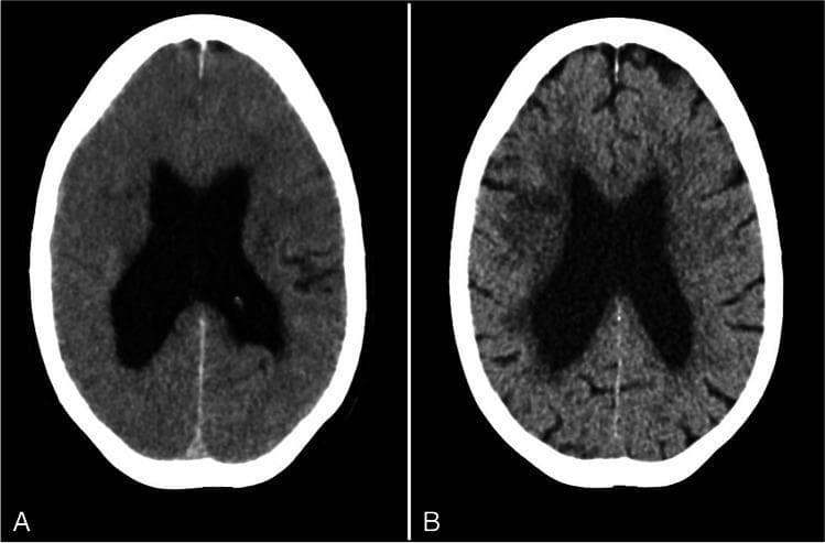 This Comparison Chart displays two axial non-contrast CT scans of the brain, demonstrating the evolution of cerebral edema. Image A (left) was taken immediately after a mechanical thrombectomy, showing significant diffuse brain swelling. Key diagnostic findings include the effacement of the cerebral sulci and cortical crowding, indicating increased intracranial pressure and loss of normal cerebrospinal fluid (CSF) spaces on the brain surface. The lateral ventricles appear prominent. Image B (right) is a follow-up scan from 4 days later, showing the resolution of the swelling. In this follow-up, the cerebral sulci have reappeared and are clearly visible, indicating a reduction in parenchymal pressure. A small hypodense area in the right middle cerebral artery territory is visible, consistent with a localized infarct. This comparison serves as an educational tool for identifying radiological signs of acute brain swelling and monitoring its clinical resolution over time.