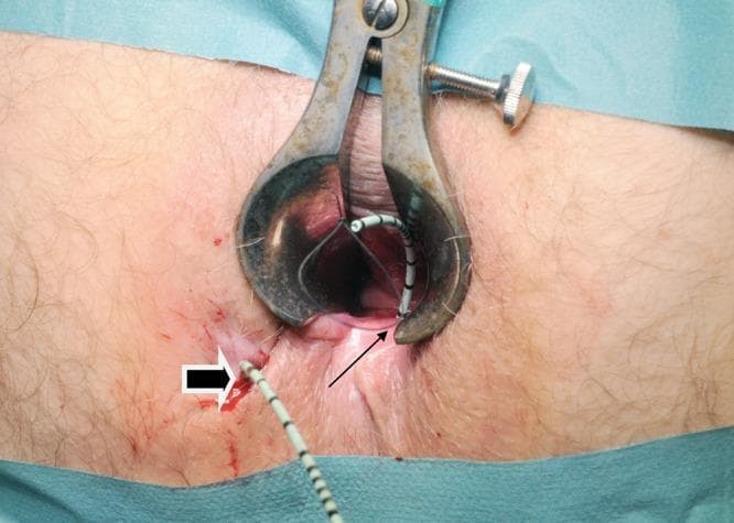Clinical photograph of a surgical procedure for a complex fistula-in-ano. The image shows the perianal region with a metal anal speculum/retractor positioned to provide visualization of the anal canal. A 6Fr open-end ureteral catheter is seen threaded through the fistula track. A thick white-outlined arrow indicates the external cutaneous opening of the fistula, while a thin black arrow points to the internal opening within the anal canal. A 1/0 nylon suture is visible passing through the lumen of the catheter, forming a loop to facilitate the subsequent placement of a vascular sling or seton. The surrounding skin shows mild surgical inflammation and minor hemorrhagic spotting consistent with the procedure. This image illustrates a technique for seton placement in colorectal surgery, demonstrating the pathway from the internal to the external sphincter openings. Target audience: Colorectal surgeons and medical students studying proctology and surgical interventions for perianal disease.