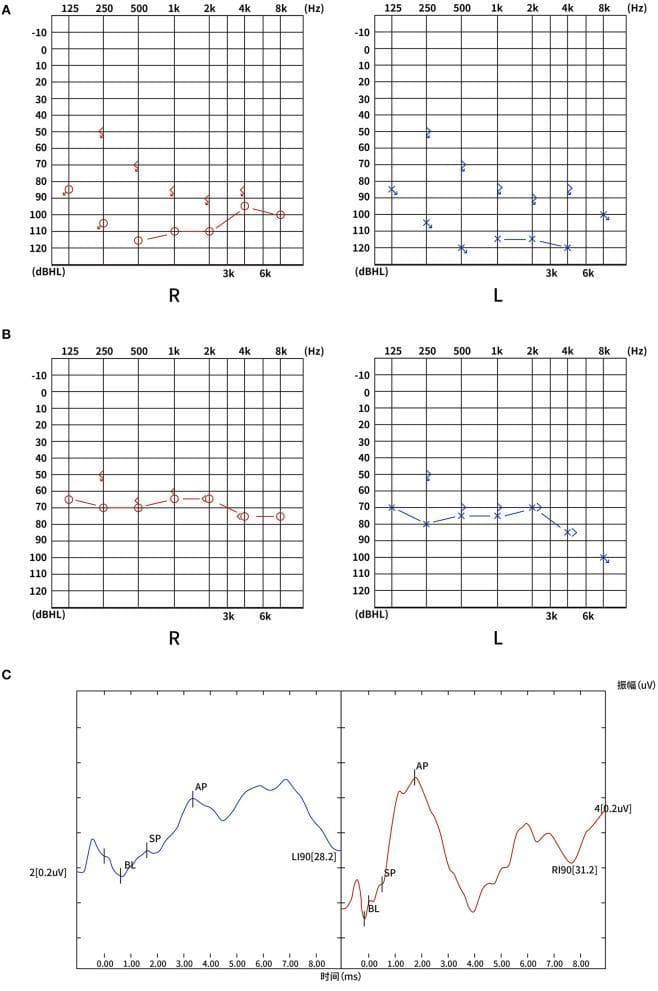 This composite diagnostic image illustrates the audiological evaluation of a patient with bilateral sudden sensorineural hearing loss (SSNHL). Panel A displays the admission pure-tone audiograms (PTA) for the right (R) and left (L) ears, showing total hearing loss with thresholds primarily between 80-120 dBHL across frequencies from 125 Hz to 8 kHz. Panel B shows the follow-up audiogram after three months, demonstrating a partial recovery to severe hearing loss, with thresholds improved to the 60-80 dBHL range. Panel C presents electrocochleogram (ECochG) waveforms for both ears at 90 dBnHL. The waveforms clearly identify the summating potential (SP) and action potential (AP) peaks. The SP/AP ratios (0.25 for the right ear and 0.33 for the left ear) are within normal clinical limits, helping to localize the pathology and assess cochlear function. The images provide a longitudinal view of disease progression and recovery, useful for medical education on otolaryngology and neuro-otology cases involving vascular or idiopathic hearing loss.