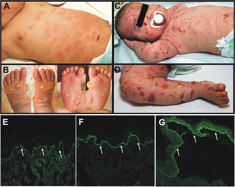A multi-panel figure illustrating the clinical and diagnostic hallmarks of infantile bullous pemphigoid (BP). Panels A-D display clinical photographs of an infant. Panel A shows erythematous, urticarial plaques on the trunk with characteristic raised rims and dusky centers. Panel B depicts multiple tense, fluid-filled bullae and firm blisters on the hands and feet. Panels C and D illustrate a severe disease relapse with widespread blistering, erosions, and denuded skin across the face, trunk, and extremities. Panels E-G present immunofluorescence microscopy (200x magnification). Direct immunofluorescence (E and F) demonstrates continuous linear deposits of IgG and C3 along the epidermal basement membrane zone (indicated by white arrows). Indirect immunofluorescence on salt-split skin (G) shows circulating IgG antibodies binding specifically to the epidermal roof of the blister, a diagnostic finding for BP. The image serves as an educational resource for recognizing pediatric autoimmune blistering diseases and understanding the correlation between clinical morphology and immunopathological findings.