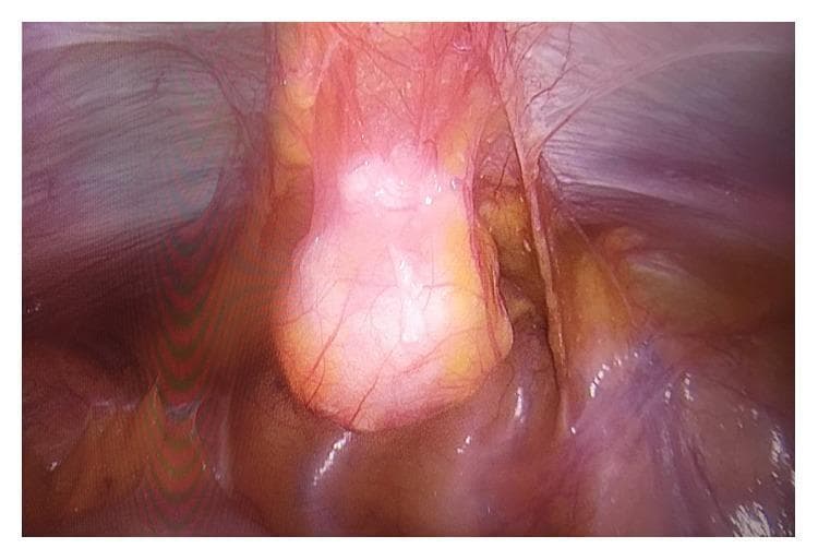 This clinical photograph is an intraoperative laparoscopic view of the pelvic cavity, specifically demonstrating a urachal cyst. Centrally, a cystic mass is visible within the median umbilical ligament. The mass is ovoid, translucent pink to yellow in color, and exhibits a smooth, glistening surface with prominent branching superficial vasculature. Anatomically, the lesion is situated superior to the dome of the bladder, approximately 2 cm from the bladder wall. Surrounding peritoneal folds and retroperitoneal fatty tissue are visible, providing orientation within the preperitoneal space. This image serves as an educational example of urachal pathology, illustrating the typical appearance and anatomical relationship of a mucinous cystic tumor of the urachus during surgical excision. The visual features—specifically the translucent quality and location along the midline embryonic remnant—are characteristic of urachal cysts or neoplasms of low malignant potential.