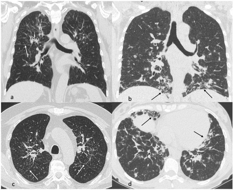 This diagnostic image provides a comparative CT scan analysis of sarcoidosis and Granulomatous-Lymphocytic Interstitial Lung Disease (GLILD). Images (a) and (c) depict thoracic CT views of a 68-year-old male with sarcoidosis, showing characteristic perilymphatic nodules and periscissural involvement (white arrows) concentrated in the mid-to-upper lung fields, alongside perihilar fibrosis. In contrast, images (b) and (d) present CT findings of a 38-year-old female with Common Variable Immunodeficiency (CVID) and GLILD, where the pathology is predominantly located in the lower lung fields. These findings include dense consolidations, multiple nodules, and prominent reticulations (black arrows) with associated fibrotic changes. The comparison highlights key differential diagnostic features: the upper lobe/perihilar distribution of sarcoidosis versus the lower lobe/reticular predominance of GLILD. The imaging modality is High-Resolution Computed Tomography (HRCT) in both axial and coronal planes, serving as a critical tool for identifying patterns of interstitial lung disease and guiding clinical management in pulmonology and immunology.