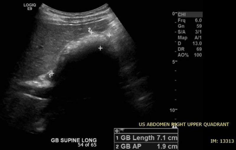 Diagnostic Image: Abdominal Ultrasound (US). Modality: B-mode sonography of the Right Upper Quadrant (RUQ) in the supine longitudinal plane. Anatomical Region: Gallbladder and adjacent liver parenchyma. Findings: The gallbladder lumen contains multiple well-defined, hyperechoic structures consistent with cholelithiasis (gallstones). These structures exhibit prominent posterior acoustic shadowing, a characteristic feature of mineralized calculi. Calipers measure the gallbladder length at 7.1 cm and the anteroposterior (AP) diameter at 1.9 cm, both of which fall within normal physiological limits. There is no visible evidence of gallbladder wall thickening or pericholecystic fluid in this view. Clinical Significance: The image demonstrates uncomplicated cholelithiasis, providing a classic example of gallstones for educational purposes in gastroenterology and radiology. Target Audience: Medical students and residents learning ultrasound interpretation of the biliary system.