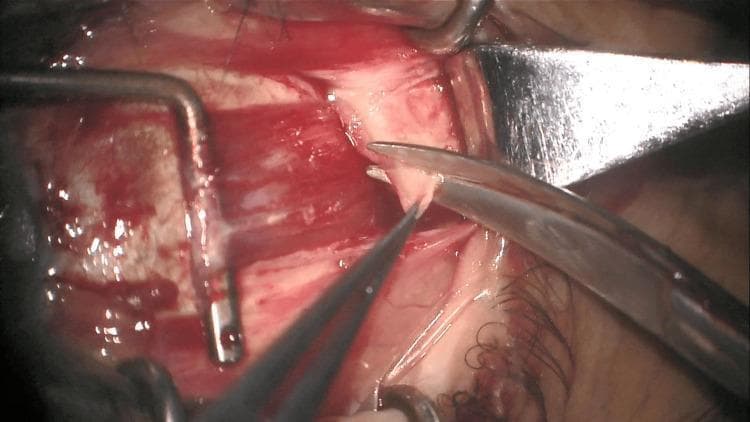 This clinical photograph captures an intraoperative view of an ophthalmic surgical procedure, specifically a biopsy of a mass located near the lateral rectus muscle. The surgical field demonstrates several specialized instruments in use: a strabismus muscle hook is utilized to retract and suspend the muscle belly away from the globe, while fine dissection scissors are seen isolating and excising a sample of tissue. The visible anatomy includes the extraocular muscle, characterized by its reddish-pink longitudinal muscle fibers, and the surrounding scleral surface of the eye globe. The biopsy technique shown involves the longitudinal division of fibers to obtain a superficial sample from the orbital surface of the rectus muscle. Hemorrhagic staining and surgical manipulation of the conjunctiva and muscle capsule are evident, reflecting the active dissection. This image serves as a teaching tool for oculoplastic or strabismus surgery, illustrating the precise instrumentation and anatomical handling required for extraocular muscle tissue sampling while minimizing mechanical complications.