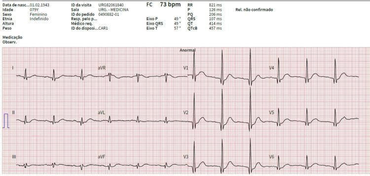 This diagnostic image is a 12-lead electrocardiogram (ECG) tracing showing a 79-year-old female patient with a heart rate of 73 bpm. The tracing demonstrates a first-degree atrioventricular (AV) block, characterized by a prolonged PR interval (PQ) of 206 ms. A notable morphological finding is the presence of prominent R-waves in the right precordial leads (V1, V2, and V3), which are accompanied by associated Q-waves. This pattern can be suggestive of posterior wall fibrosis or septal ventricular hypertrophy. The QRS duration is measured at 107 ms, and the corrected QT (QTcB) is 457 ms. Axis measurements show a P-wave axis of 49ยฐ, a QRS axis of 49ยฐ, and a T-wave axis of 57ยฐ. ST segments and T waves appear largely within normal limits. This ECG serves as an educational example of conduction delay and abnormal R-wave progression in the context of systemic electrolyte or structural heart considerations.