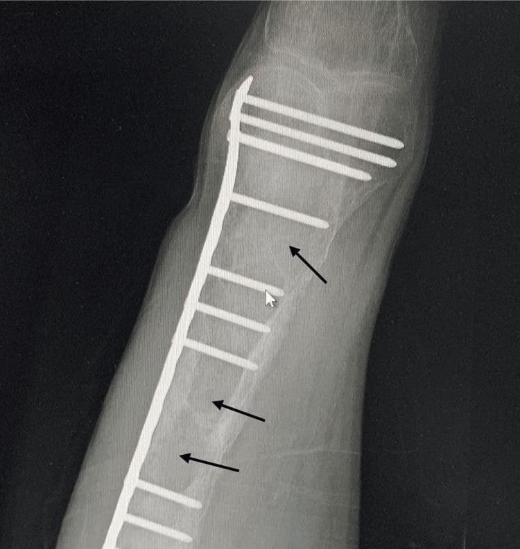 This diagnostic X-ray of a long bone (likely the femur or tibia) demonstrates advanced radiographic signs of osteitis fibrosa cystica secondary to severe hyperparathyroidism. The bone exhibits generalized osteopenia and multiple well-defined, radiolucent, cyst-like lesions (brown tumors), indicated by black arrows, which represent areas of high bone turnover and fibrous replacement. Surgical orthopedic hardware is visible, consisting of a long metallic compression plate and multiple cortical screws, signifying internal fixation of a previous pathological fracture. The bone cortex appears thinned and irregular. This image serves as a classic clinical example of skeletal manifestations in chronic kidney disease-mineral and bone disorder (CKD-MBD) or primary hyperparathyroidism, illustrating the progression from metabolic imbalance to structural skeletal failure requiring surgical intervention.