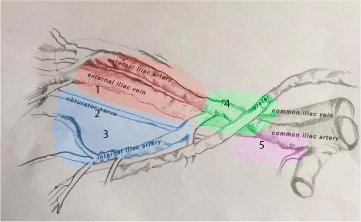 An anatomical diagram illustrating the surgical boundaries and classification of Pelvic Lymph Node Dissection (PLND) templates. The illustration depicts the major vascular and nervous structures of the pelvic cavity, including the common iliac artery and vein, external and internal iliac vessels, the obturator nerve, and the ureter. The diagram uses color-coded regions to define four levels of dissection: 1) Limited PLND (red, Area 1) focusing on the external iliac artery and vein; 2) Standard PLND (blue, Areas 1–3) extending to include the obturator nerve and internal iliac artery; 3) Extended PLND (green, Areas 1–4) incorporating the region where the ureter crosses the common iliac artery; and 4) Superextended PLND (purple, Areas 1–5) reaching the common iliac bifurcation. This educational visual is designed to standardize surgical nomenclature for lymphadenectomy in bladder and prostate cancer staging, clearly identifying the anatomical landmarks required for each surgical approach (antegade vs. retrograde).