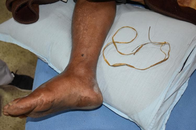 This clinical photograph displays a human lower limb resting on a pillow, illustrating complications related to snakebite management. The anatomical focus is the lower leg and foot, which exhibits significant edema (swelling) and skin tension. A small, dark, circular puncture or lesion is visible on the anterior aspect of the lower leg, suggestive of a bite site. The skin shows areas of mottled pigmentation and localized dryness, particularly around the heel and ankle. Adjacent to the limb is a discarded makeshift tourniquet made of yellow plastic rope, which was reportedly used as a tight ligature. This image serves as a clinical example of traditional first aid practices for snakebites, highlighting the physiological changes in the affected limb, such as swelling and potential tissue ischemia, as well as the use of non-medical interventions like mechanical constriction and localized topical applications.