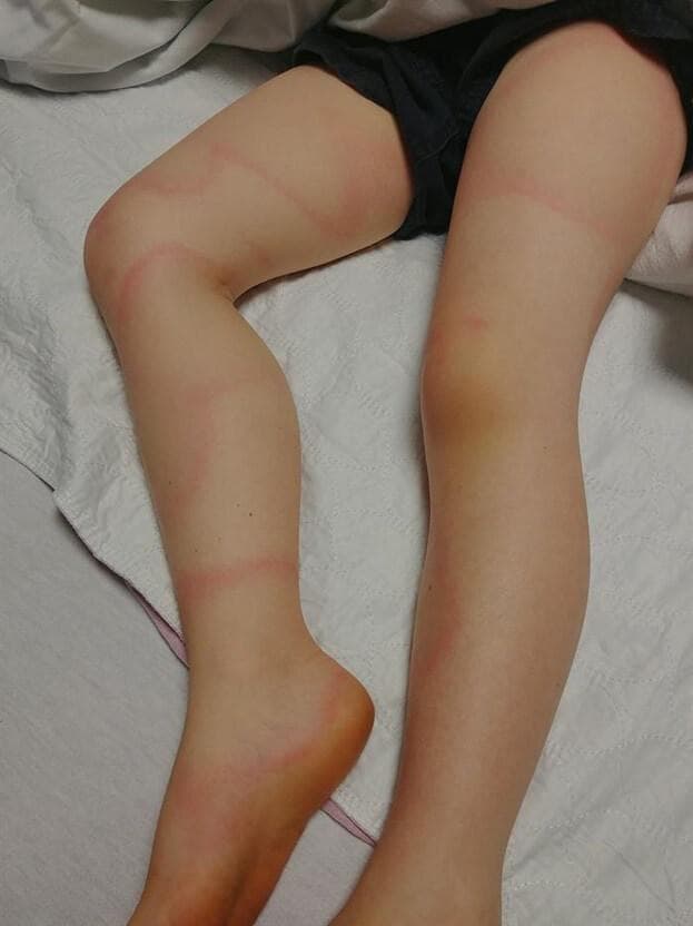 A clinical photograph of the lower extremities of a pediatric patient, demonstrating a distinctive cutaneous manifestation. The image shows multiple erythematous, annular (ring-shaped) lesions distributed across the thighs, knees, shins, and ankles. The rash is characterized by raised, pinkish-red borders that form large, asymmetric, and serpiginous patterns, some partially encircling the limbs. These lesions appear papular and lack visible scaling or central crusting, suggesting an inflammatory or migratory process such as Erythema Marginatum or Erythema Migrans. A localized area of yellowish discoloration (bruising or ecchymosis) is visible on the right knee. The morphology of these blanchable, annular lesions is a key diagnostic feature often associated with systemic conditions such as acute rheumatic fever or early-stage Lyme disease. This visual is intended for medical education in dermatology, pediatrics, and infectious diseases to assist in the identification of classic annular rash patterns.