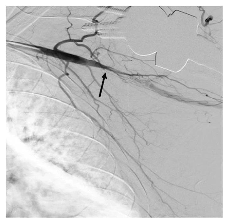 This diagnostic image is a digital subtraction angiogram (DSA) of the left upper extremity, showcasing the vascular anatomy of the subclavian and axillary regions. The primary pathological finding is a focal total occlusion of the axillary artery, indicated by a black arrow. This segment, approximately 4-5 cm in length, shows a complete absence of contrast opacification, representing a vascular blockage. Proximal to the occlusion, the subclavian artery appears patent with normal contrast flow. Several collateral vessels are visible, attempting to bypass the obstructed segment to provide distal perfusion. The image demonstrates key concepts in vascular interventional radiology, specifically the diagnostic identification of arterial occlusive disease and the assessment of collateral circulation. The contrast filling distal to the site of occlusion suggests the presence of distal patency in the brachial artery supplied by these collaterals. This material is highly relevant for medical education focusing on peripheral artery disease (PAD), acute limb ischemia, and diagnostic angiography interpretation.