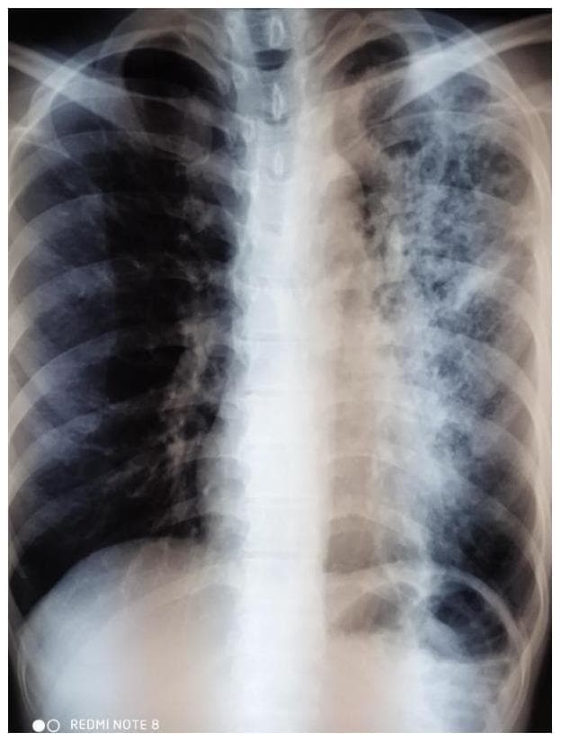 This diagnostic image is an anteroposterior (AP) chest X-ray demonstrating classic radiographic features of secondary pulmonary tuberculosis. The primary pathology is localized to the left lung field, which shows multiple thick-walled cavitating lesions in the upper lobe, indicative of tissue necrosis and cavitation. Associated patchy, ill-defined infiltrates and heterogeneous opacities are distributed throughout the left middle and lower zones, suggesting endobronchial spread or active consolidation. Global lung changes include signs of hyperinflation, evidenced by flattened diaphragms and increased radiolucency. There is notable blunting of the left costophrenic angle, consistent with a small pleural effusion or pleural thickening. The right lung field appears relatively clear but hyperexpanded. This image serves as an educational example of advanced cavitary tuberculosis and the typical distribution of post-primary tuberculous infection in an adult patient.