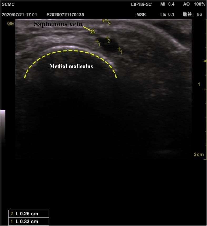 This diagnostic image is a transverse-view ultrasound of the ankle region, specifically focused on the anatomy of the great saphenous vein at the level of the medial malleolus. The ultrasound displays the vein as a superficial, hypoechoic circular structure located just beneath the skin surface. An anatomical landmark, the medial malleolus, is outlined by a dashed yellow line, appearing as a curved hyperechoic bony surface with posterior acoustic shadowing. Linear measurements are applied to the saphenous vein to determine dimensions relevant for clinical procedures such as peripheral intravenous catheterization. Marker '1' indicates the maximum transverse width (0.33 cm), while marker '2' indicates the depth from the skin surface to the top of the vessel (0.25 cm). The image includes technical parameters such as an 18 MHz linear probe frequency and a standardized depth setting of 2 cm. This visual serves as an educational guide for ultrasound-guided vascular access in pediatric patients, illustrating the relationship between cutaneous landmarks and underlying venous structures.