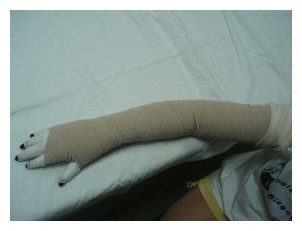 This clinical photograph displays a multilayered compression bandaging technique applied to a human upper extremity, commonly used in the management of breast cancer-related lymphedema. The bandage system consists of a white stockinette or padding under-layer, visible at the fingers and the proximal axillary region, followed by beige short-stretch bandages applied in a spiral, overlapping fashion. The wrapping extends from the metacarpals, through the wrist and elbow, up to the upper arm, conforming to the limb's anatomical contour while maintaining even pressure. Distal phalanges are left exposed to monitor neurovascular status. This visual demonstrates the standard application of Complex Decongestive Therapy (CDT) components designed to facilitate lymphatic drainage and reduce limb volume in chronic edematous states (Stages II and III). The image serves as an educational reference for correct bandaging morphology, showing the typical 'ribbed' texture created by precise overlapping layers to prevent garment slippage and ensure therapeutic compression levels of 50-60 mmHg.