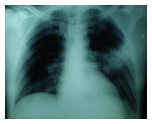 This diagnostic image is a posterior-anterior (PA) chest X-ray illustrating a significant pulmonary pathology. The primary finding is a dense, relatively homogeneous opacity located in the left lung field, consistent with lobar consolidation. This finding is characteristic of community-acquired pneumonia, specifically involving the left lung. In contrast, the right lung field appears clear with normal bronchovascular markings and no evidence of infiltrates or pleural effusion. The mediastinal shadow, including heart size and position, appears within normal limits. The costophrenic angles are sharp, and the diaphragmatic contours are intact. This radiograph serves as a classic educational example of pulmonary consolidation, highlighting the visual differences between air-filled lung parenchyma and fluid or cell-filled alveoli as seen in infectious pneumonia.