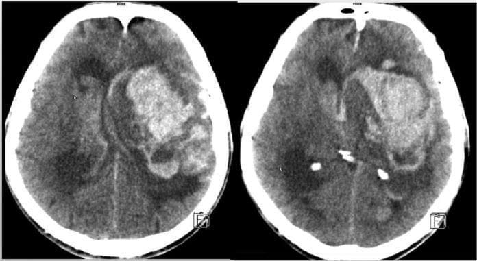 This diagnostic image consists of two axial non-contrast CT scan slices of the brain. The scans demonstrate a massive, irregularly shaped intra-axial hyperdensity in the left hemisphere, specifically involving the fronto-temporal region. This hyperdense mass is indicative of acute intracerebral hemorrhage (ICH). The lesion exerts a significant mass effect, resulting in midline shift towards the right and effacement of the surrounding cerebral sulci. There is clear evidence of intraventricular extension (ventricular rupture), visible as hyperdense material within the lateral ventricles. These findings are consistent with a severe hemorrhagic stroke. The image serves as a clinical example of intracranial bleeding complications, often associated with severe thrombocytopenia or coagulopathy in a neurosurgical context. It is suitable for medical education regarding radiological identification of acute stroke and secondary ventricular involvement.