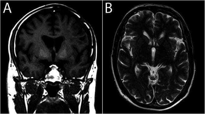 Diagnostic neuroimaging comparison featuring two magnetic resonance imaging (MRI) slices of the human brain. Image A is a non-contrast coronal T1-weighted image showing bilateral, symmetric hyperintensity (increased signal) in the globi pallidi, which suggests shortened T1 relaxation time due to substances such as gadolinium-ferritin complexes or manganese. Image B is an axial T2-weighted image at the level of the basal ganglia. In Image B, the cerebrospinal fluid (CSF) in the ventricles and sulci appears bright (hyperintense), while the white matter is relatively dark (hypointense) and gray matter is intermediate. The globi pallidi in the T2-weighted image show physiological hypointensity. The comparison illustrates that while significant T1 shortening is visible as hyperintensity in the deep brain nuclei, corresponding T2 shortening effects may be negligible or invisible to the naked eye. This visual material is intended for intermediate to advanced medical learners studying neuroradiology, specifically focusing on signal intensity changes in deep-brain nuclei and the effects of paramagnetic substances on relaxation times.