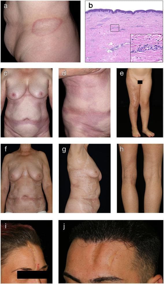 A composite medical image illustrating various clinical and histological presentations of morphea (localized scleroderma). (A) Clinical photograph of plaque-type morphea on the trunk, showing a well-defined oval patch with a sclerotic, ivory-white center and a peripheral erythematous-violaceous 'lilac ring' indicative of active inflammation. (B) H&E stained histopathology (40x, 200x) showing a thinned epidermis, significant dermal sclerosis with thick eosinophilic collagen bundles, and periadnexal lymphocytic infiltrates. (C-D, F-G) Examples of generalized morphea on the torso, progressing from early inflammatory erythematous-violaceous coalescing patches (C-D) to late-stage sclerotic pink-white patches with central induration (F-G). (E) Linear morphea presenting as a band-like atrophic hyperpigmented plaque following Blaschko lines on a limb. (H) Deep morphea showing limb asymmetry due to underlying tissue atrophy. (I-J) Linear morphea en coup de sabre, characterized by depressed, sclerotic paramedian forehead plaques and cicatricial alopecia. This collection serves as a diagnostic guide for recognizing different clinical subtypes and evolutionary stages of morphea.