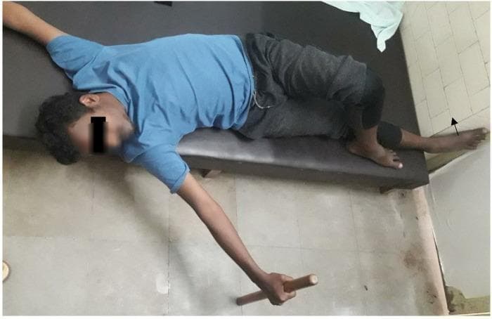 This clinical photograph demonstrates a specific therapeutic positioning technique in the supine position for curve-specific correction, typically used in physical therapy for scoliosis or pelvic obliquity. The patient is lying supine on a padded examination couch. To address transverse and sagittal plane pelvic asymmetries, the left leg is crossed over the straight right leg, with the left hip and knee flexed and the left foot placed beside the right knee. This configuration aims to bring a posteriorly rotated left pelvis forward. The patient's upper body is stabilized with arms extended laterally; the right hand holds a cylindrical wooden dowel, likely used to facilitate thoracic stabilization or derotation during corrective exercises. This posture leverages the lower extremities as a lever arm to assist in lumbar and pelvic realignment. The image serves as an educational example of conservative rehabilitative management for spinal deformities and pelvic malalignment.