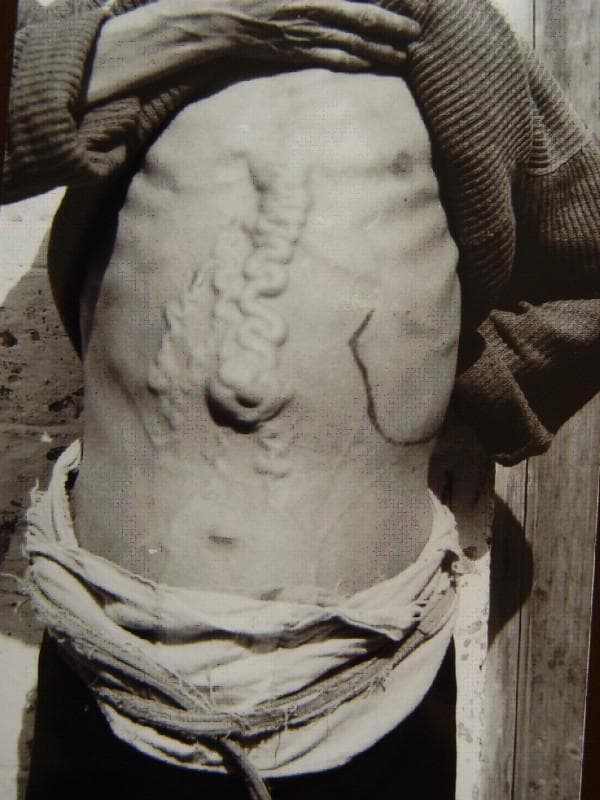 This clinical photograph displays the abdominal region of a patient with advanced schistosomiasis, illustrating severe portal hypertension. The most prominent feature is the presence of massively dilated and tortuous abdominal collateral veins (caput medusae) originating from the epigastric region and extending toward the umbilicus. A central, large, rope-like vein exhibits extreme serpentine morphology along the midline. On the left side of the abdomen (patient's left), an ink marking outlines the margin of a significant megalosplenia (enlarged spleen), extending well below the costal margin. The abdomen appears distended, suggestive of underlying ascites. These clinical signs—prominent venous collaterals and splenomegaly—are classic manifestations of late-stage hepatic schistosomiasis, where fibrotic changes in the liver obstruct portal blood flow, forcing the development of systemic-portal shunts and causing congestive splenomegaly. This image serves as an educational example of the physical examination findings associated with chronic hepatosplenic parasitic infections and secondary portal hypertensive syndrome.