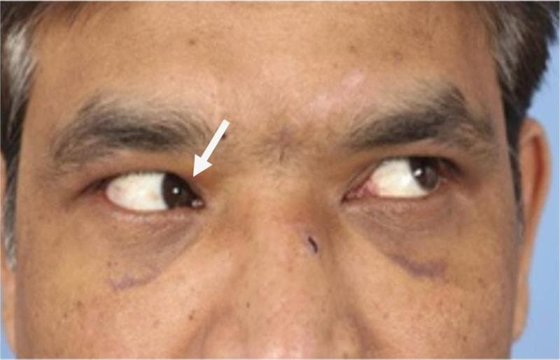 A clinical photograph of an adult male patient demonstrating extraocular muscle restriction during a diagnostic gaze test. The patient is attempting a superior-lateral (upper left) gaze. While the left eye successfully abducts and elevates, the right eye exhibits a failure to elevate during adduction, a clinical sign often associated with Brown syndrome or mechanical entrapment. A white arrow points to the right eye's medial canthus area, highlighting the restricted elevation. Visible periorbital ecchymosis (bruising) and swelling are present infraorbitally bilaterally, consistent with trauma or recent maxillofacial surgery. A faint horizontal surgical scar is visible on the left side of the face. This visual represents an orthoptic assessment of a patient with a nasoorbitoethmoidal (NOE) fracture, specifically illustrating preoperative diplopia and ocular motility deficits secondary to facial trauma. The image is intended for educational use in ophthalmology and trauma surgery to demonstrate mechanical restriction of the inferior oblique or superior oblique tendon complex.