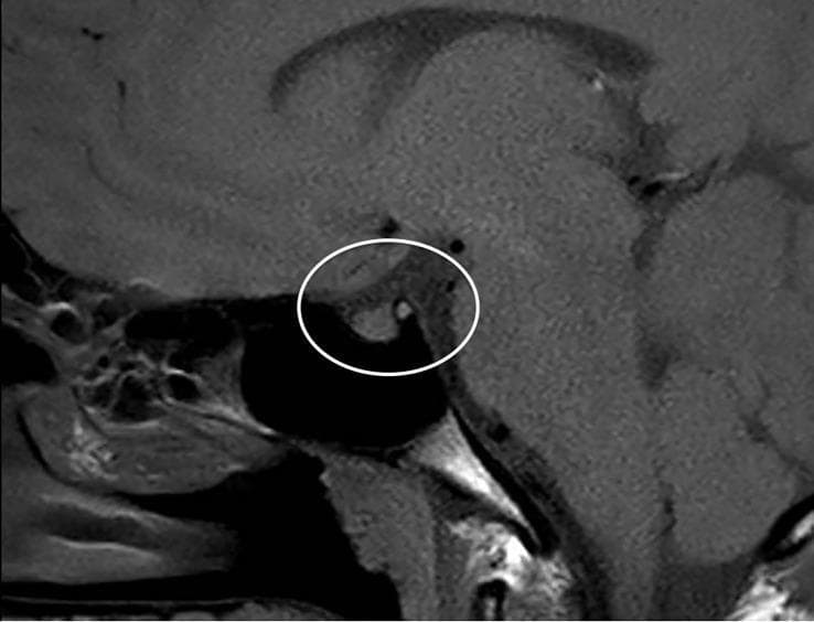 This diagnostic image is a T1-weighted sagittal MRI of the brain, focused on the sellar and suprasellar regions. The central focus, highlighted by a white circle, demonstrates two primary pathological findings consistent with neurohypophysitis. First, there is a visible thickening of the pituitary stalk (infundibulum), measured at a maximum diameter of 4 mm. Second, the image shows the absence of the normal 'posterior pituitary bright spot,' which typically represents the hyperintense signal of stored vasopressin in the neurohypophysis on T1 sequences. The surrounding anatomical structures, including the optic chiasm, corpus callosum, and sphenoid sinus, are visible for orientation. These neuroradiological features are clinically significant for the diagnosis of central diabetes insipidus (CDI), illustrating the inflammatory involvement of the infundibulo-hypophyseal axis.