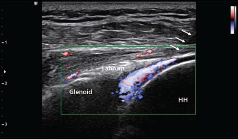 A musculoskeletal ultrasound image in a posterior view demonstrates an ultrasound-guided intra-articular injection of the shoulder joint. The B-mode image shows the glenohumeral joint anatomy, with the glenoid on the left, the humerus head (HH) on the right, and the triangular, hyperechoic posterior labrum situated between them. White arrows indicate the trajectory of the needle approaching the joint space from a posterior-lateral direction. A green rectangular color Doppler box is superimposed over the joint, displaying prominent red and blue signals that confirm the dynamic flow of the injected substance into the articular cavity. This technique is used in clinical practice to ensure precise delivery of therapeutic agents, such as triamcinolone acetonide (TA) or polydeoxyribonucleotide (PDRN), for conditions like hemiplegic shoulder pain (HSP).