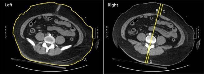 This diagnostic image consists of two axial non-contrast CT slices of the abdomen at the L4-L5 vertebral level, demonstrating standardized methods for measuring anthropometric parameters. The left panel illustrates the measurement of waist circumference (A), indicated by a yellow trace following the external skin contour at the umbilical level. The right panel displays several linear measurements: the sagittal abdominal diameter (B), a vertical line extending from the anterior skin surface to the posterior skin surface; the anterior subcutaneous adipose tissue (SAT) depth (C), measuring the distance between the skin and the anterior rectus sheath/linea alba; and the posterior SAT depth (D), measuring the distance from the skin to the tip of the vertebral spinous process. Anatomical structures visible include the vertebral column, paraspinal muscles, psoas major muscles, loops of bowel, and a significant layer of subcutaneous fat. These images serve as an educational guide for quantifying central adiposity and body composition using radiological cross-sections.
