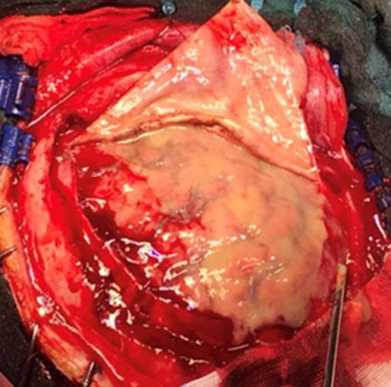 An intraoperative clinical photograph showing a neurosurgical procedure (craniotomy) for the management of an extensive subdural empyema. The image displays a wide surgical field with the dura mater retracted, revealing a thick, viscous, yellowish-white purulent collection that covers the majority of the visible cerebral hemisphere. The underlying and adjacent brain parenchyma exhibits significant congestion and hyperemia, characterized by a deep reddish hue and prominent vascularity, indicative of severe inflammatory response. Surgical instruments, including retractors and a suction tip, are visible at the margins of the craniotomy. This visual demonstrates the clinical manifestation of a large-scale intracranial infection and the necessity of surgical drainage to alleviate mass effect and control the infectious process within the subdural space.