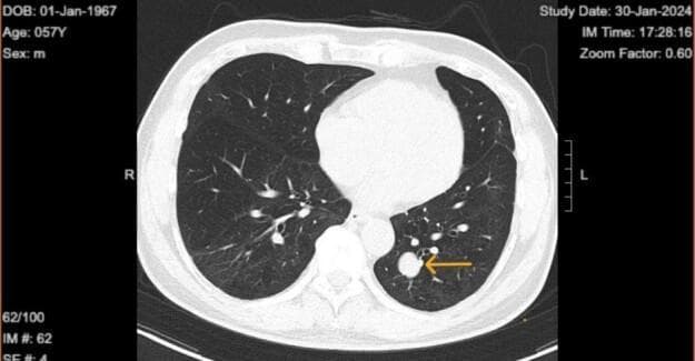 This diagnostic image is an axial slice of a non-contrast chest computed tomography (CT) scan using a lung window setting. It reveals a solitary pulmonary nodule located in the posterior segment of the left lower lobe. The nodule is characterized by its well-circumscribed, smooth margins and a solid, homogenous internal density without visible evidence of cavitation, internal calcification, or spiculated borders. An orange arrow specifically highlights the lesion's position. The surrounding lung parenchyma is clear, showing no signs of secondary infiltration, obstructive atelectasis, or pleural effusion. The mediastinal structures and the contralateral right lung appear normal. In a clinical context, such well-demarcated solitary lung tumors, especially when stable over time, may represent benign entities such as a solitary fibrous tumor (SFT) or a hamartoma, though they require careful radiological monitoring to differentiate from early-stage primary lung carcinoma. This image serves as a teaching tool for recognizing the features of a well-defined solitary pulmonary nodule and understanding its diagnostic approach.
